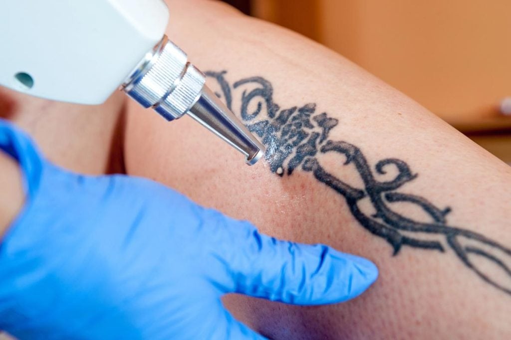 laser tattoo removal on leg