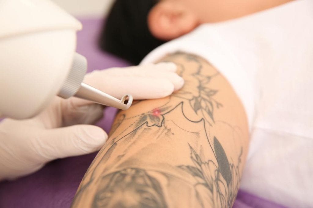 woman undergoing laser tattoo removal