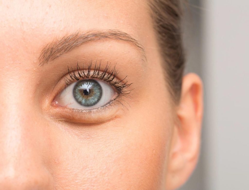 blue-eyed woman with puffy under-eyes