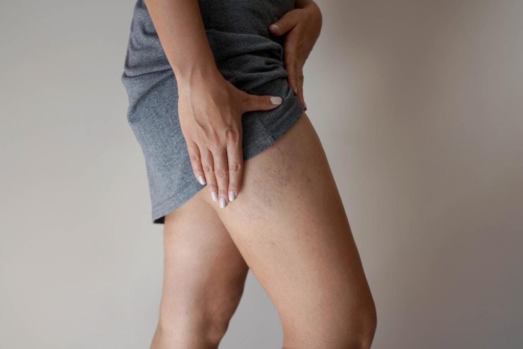Close-up of a person showing spider veins on the thigh, highlighting a common vascular condition often treated at vein centers.