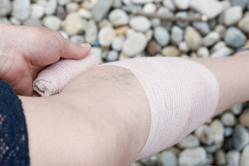 Hand applying a compression bandage around a leg with spider veins, showing a supportive treatment for vein conditions