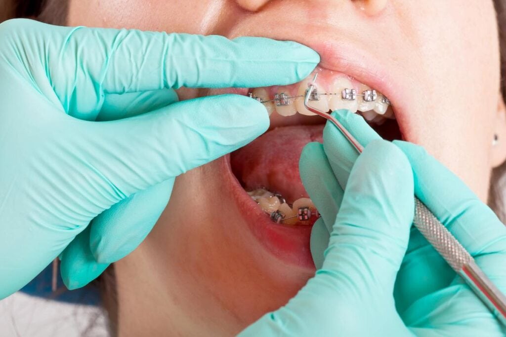 teen at orthodontist getting braces adjusted